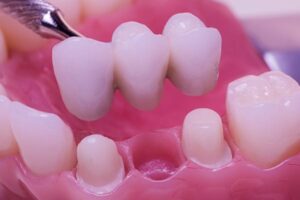 missing-teeth